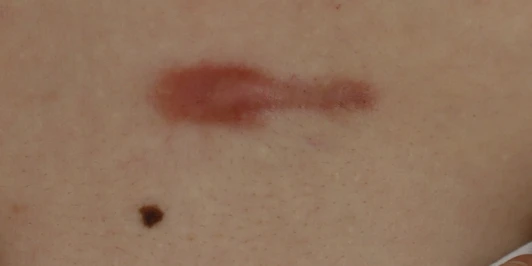 Skin hypertrophic scar photos