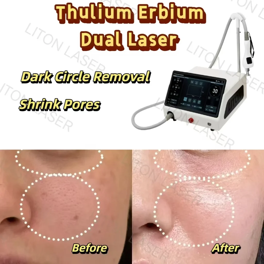 Thulium erbium laser to remove dark circles and shrink pores