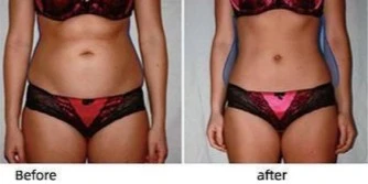 Coolsculpting Abdomen Before and After