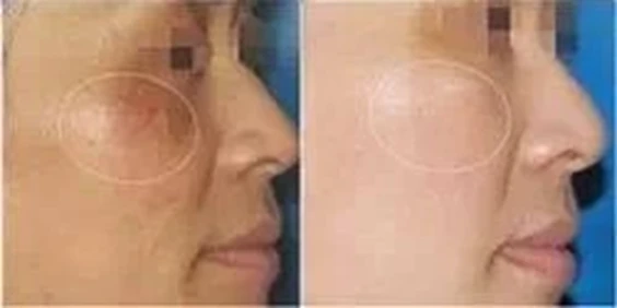 pico laser melasma treatment before and after