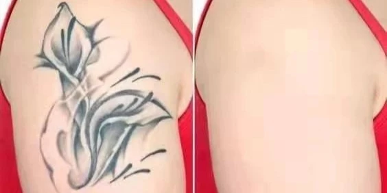 pico laser tattoo removal before and after
