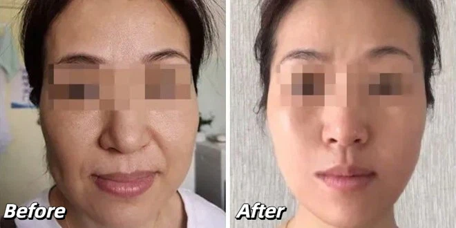 EMface treatment before and after photos