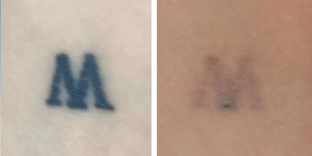 Q switch laser tattoo removal before and after photos