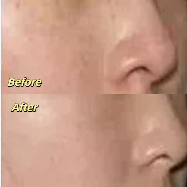 Q switch laser treatment for freckles before and after
