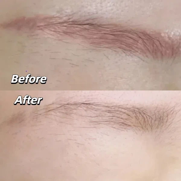 Q-switched laser eyebrow tattoo removal before and after
