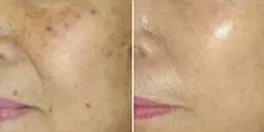 Q-switched laser removal of age spots before and after