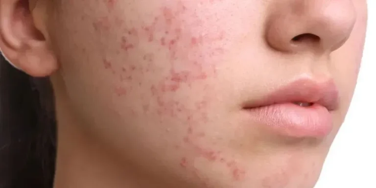 Acne on female face