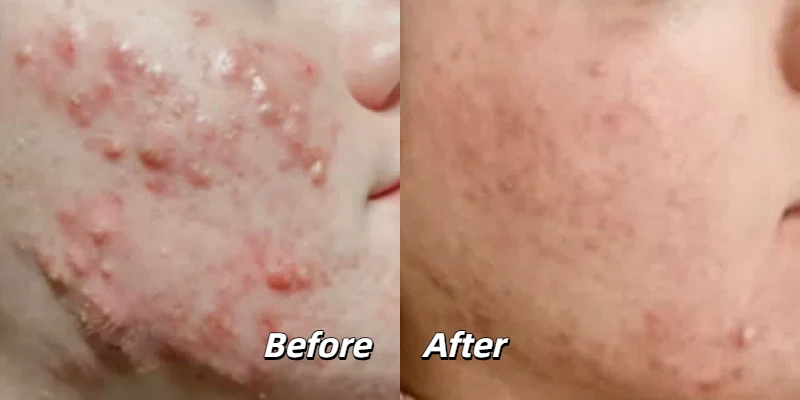 Fusion Cold Plasma Facial Acne Treatment Before and After