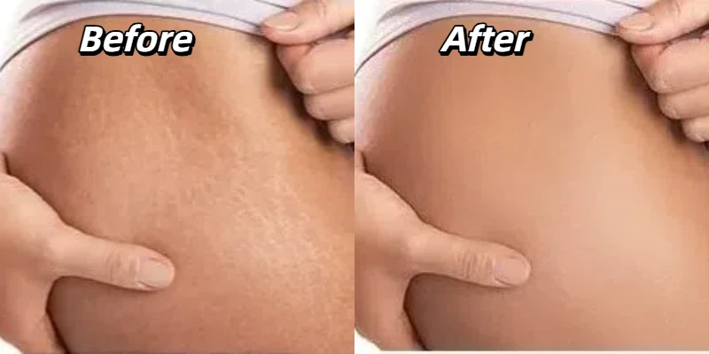 Fusion Cold Plasma Skin Tightening Before and After