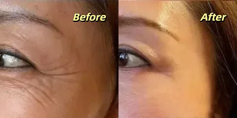 Fusion Cold Plasma Wrinkle Removal Before and After