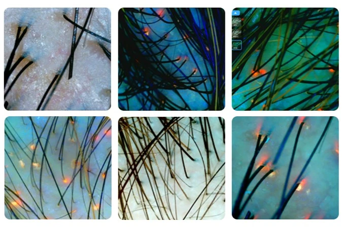 Skin analyzer scalp test photo