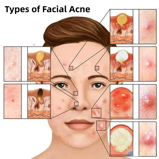 Types of Facial Acne
