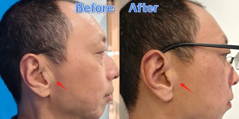 Before and after facial wrinkle treatment