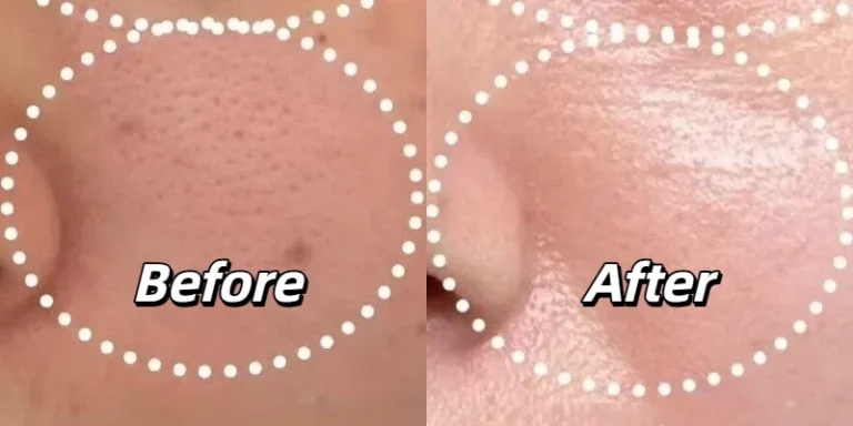 Before and after thulium laser treatment for enlarged pores