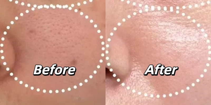 Before and after thulium laser treatment for enlarged pores