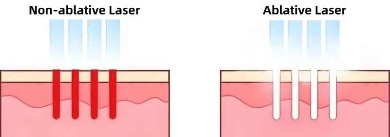 Comparison of non-ablative laser and ablative laser