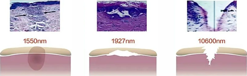 Skin comparison between non-ablative, micro-ablative, and ablative lasers