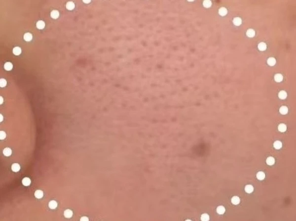Skin with large pores