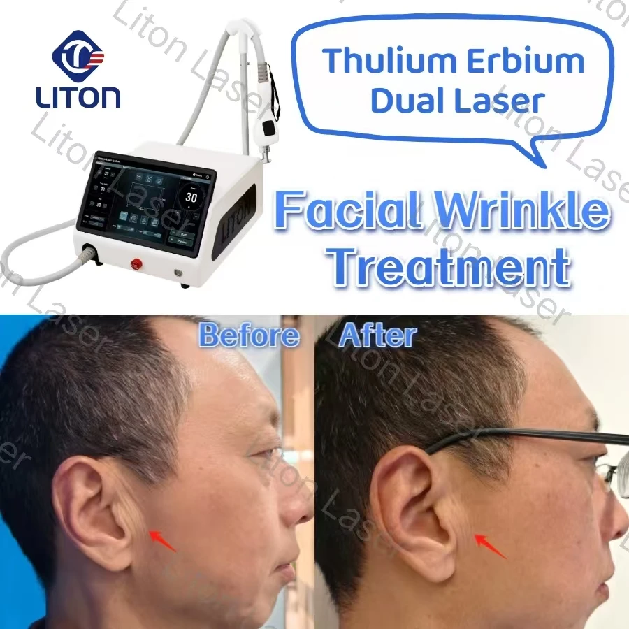 Thulium erbium laser treatment for facial wrinkles